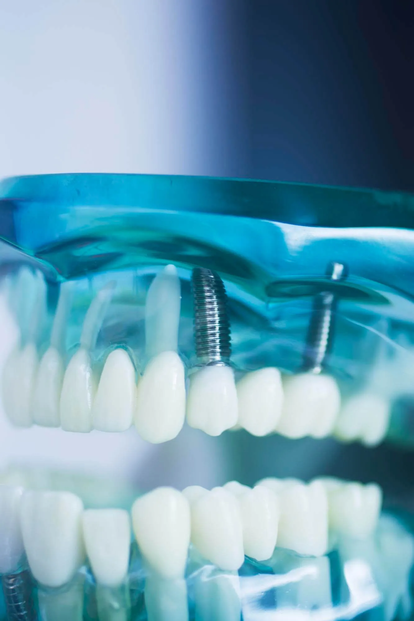 beneficios de los implantes dentales en granada