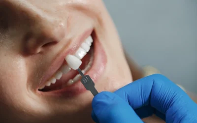 Cuándo y por qué recurrir a las carillas dentales
